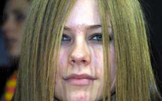 Болезнь Лайма: Аврил Лавин, Белла Хадид, Джастин Бибер, Эшли Олсен. Фото, причины и лечение